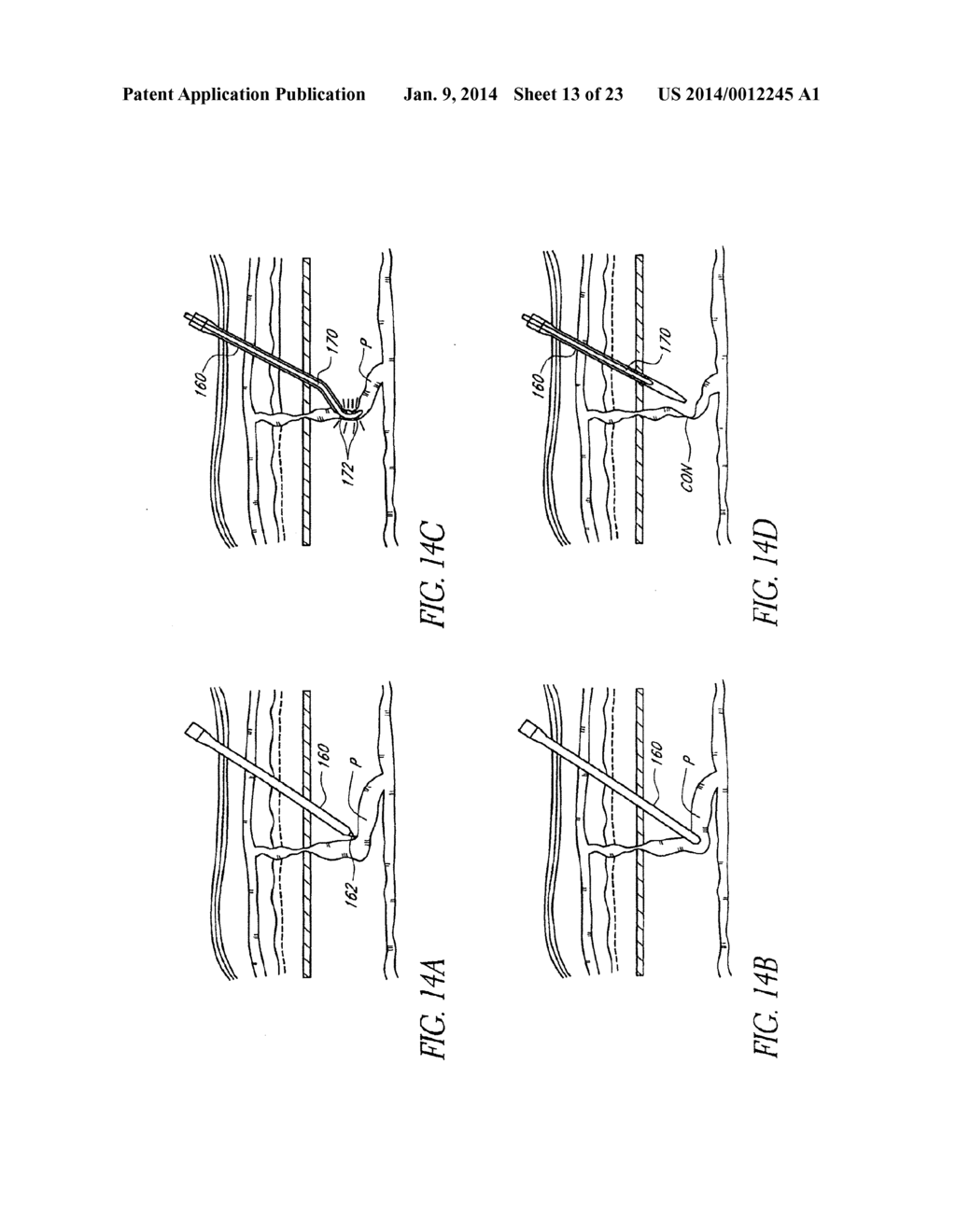 METHODS AND APPARATUS FOR COAGULATING AND/OR CONSTRICTING HOLLOW     ANATOMICAL STRUCTURES - diagram, schematic, and image 14