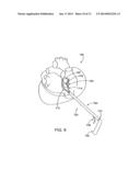 CARDIAC TREATMENT DEVICES AND METHODS diagram and image