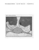 Ultrasound Enhanced Selective Tissue Removal Method and Apparatus diagram and image