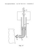 Ultrasound Enhanced Selective Tissue Removal Method and Apparatus diagram and image