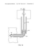 Ultrasound Enhanced Selective Tissue Removal Method and Apparatus diagram and image