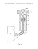 Ultrasound Enhanced Selective Tissue Removal Method and Apparatus diagram and image