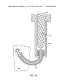 Ultrasound Enhanced Selective Tissue Removal Method and Apparatus diagram and image