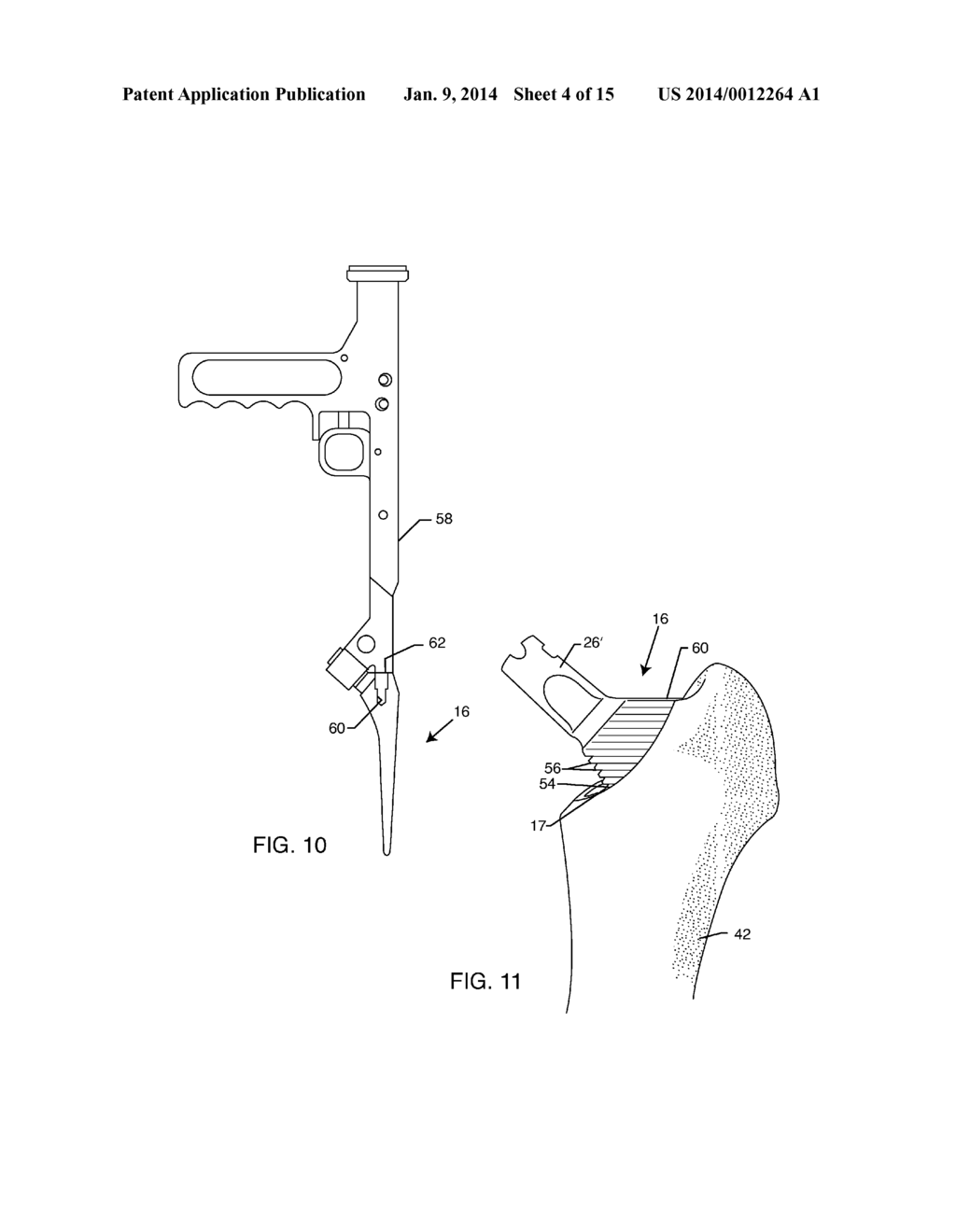 TOTAL HIP ARTHROPLASTY - diagram, schematic, and image 05