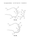 SYSTEM AND METHOD FOR JOINT RESURFACING AND REPAIR diagram and image