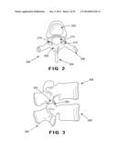 DEVICES AND METHOD FOR TREATMENT OF SPONDYLOTIC DISEASE diagram and image