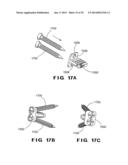 DEVICES AND METHOD FOR TREATMENT OF SPONDYLOTIC DISEASE diagram and image