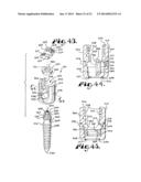 POLYAXIAL BONE SCREW WITH SHANK ARTICULATION PRESSURE INSERT AND METHOD diagram and image