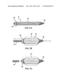 Methods of Stabilizing the Sacroiliac Joint diagram and image