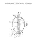 Methods of Stabilizing the Sacroiliac Joint diagram and image