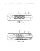 Methods of Stabilizing the Sacroiliac Joint diagram and image