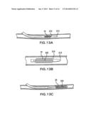 Methods of Stabilizing the Sacroiliac Joint diagram and image