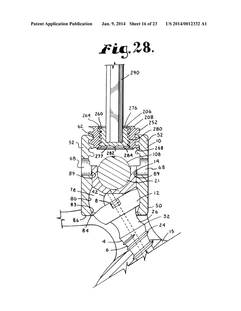 POLYAXIAL BONE SCREW WITH SHANK ARTICULATION PRESSURE INSERT AND METHOD - diagram, schematic, and image 17