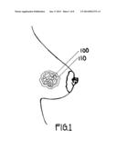 METHOD OF UTILIZING AN IMPLANT IN A HUMAN BREAST diagram and image