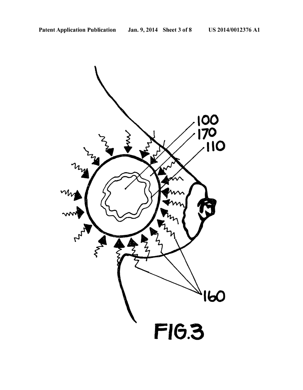 METHOD OF UTILIZING AN IMPLANT IN A HUMAN BREAST - diagram, schematic, and image 04