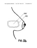 METHOD OF UTILIZING AN IMPLANT IN A HUMAN BREAST diagram and image