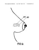 METHOD OF UTILIZING AN IMPLANT IN A HUMAN BREAST diagram and image