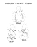 TWO FASTENER SUSPENDERS diagram and image