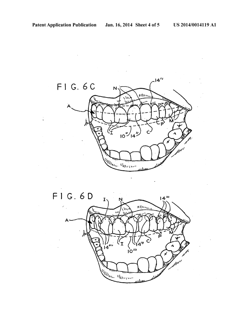 THERAPEUTIC AND PROTECTIVE DENTAL DEVICE USEFUL AS AN INTRA-ORAL DELIVERY     SYSTEM - diagram, schematic, and image 05