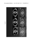 Transfection of Mesothelium Body Cavity Lining with Gene Agents Followed     by Chemotharapy to Treat Cancer of Organs in the Body Cavity diagram and image