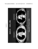 Transfection of Mesothelium Body Cavity Lining with Gene Agents Followed     by Chemotharapy to Treat Cancer of Organs in the Body Cavity diagram and image