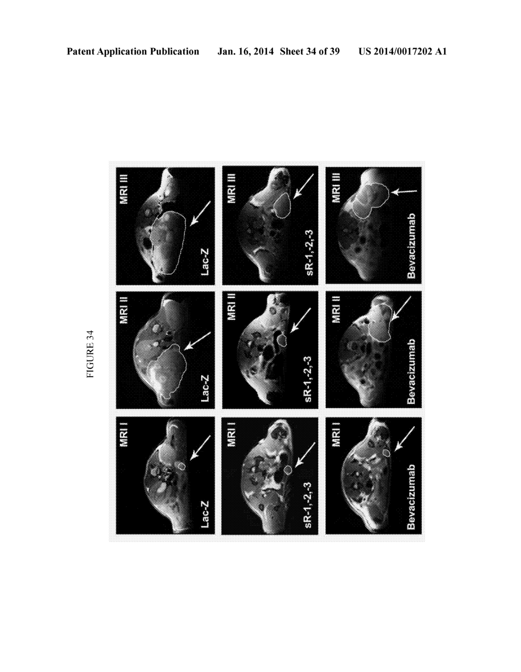 Transfection of Mesothelium Body Cavity Lining with Gene Agents Followed     by Chemotharapy to Treat Cancer of Organs in the Body Cavity - diagram, schematic, and image 35