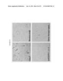 Transfection of Mesothelium Body Cavity Lining with Gene Agents Followed     by Chemotharapy to Treat Cancer of Organs in the Body Cavity diagram and image