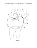 Dental Polisher diagram and image