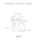 PROTECTIVE MATRIX FOR INTRACORPOREAL BIOSENSORS THAT IMPROVES     GASTROINTESTINAL LEAK DETECTION, DETECTS AIR LEAKS AFTER LUNG SURGERY,     AND MEASURES CARDIAC OUTPUT AFTER HEART SURGERY diagram and image