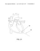 PROTECTIVE MATRIX FOR INTRACORPOREAL BIOSENSORS THAT IMPROVES     GASTROINTESTINAL LEAK DETECTION, DETECTS AIR LEAKS AFTER LUNG SURGERY,     AND MEASURES CARDIAC OUTPUT AFTER HEART SURGERY diagram and image