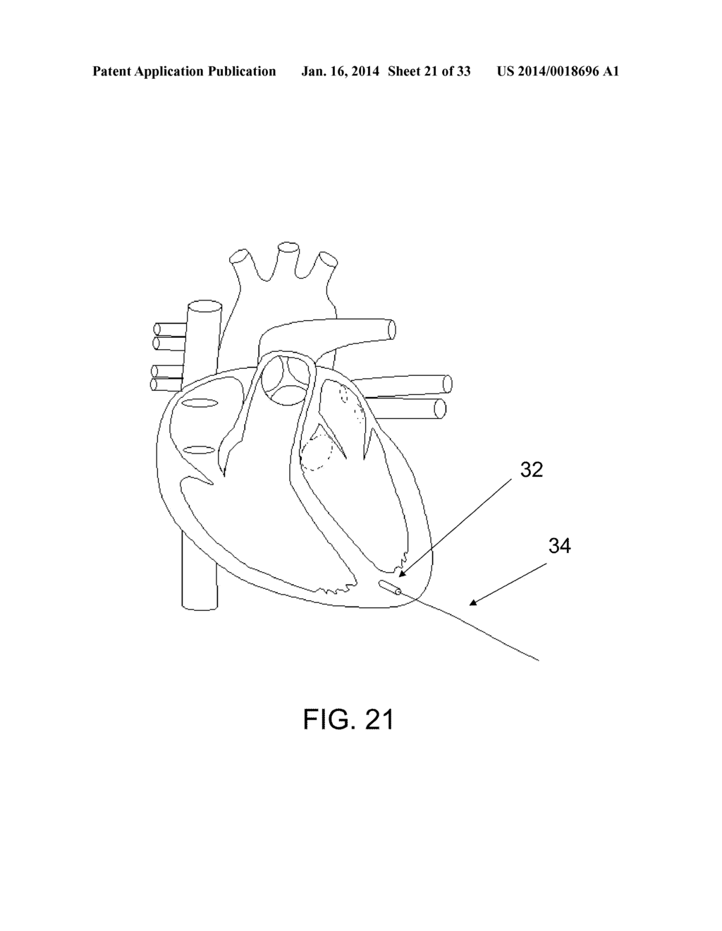 PROTECTIVE MATRIX FOR INTRACORPOREAL BIOSENSORS THAT IMPROVES     GASTROINTESTINAL LEAK DETECTION, DETECTS AIR LEAKS AFTER LUNG SURGERY,     AND MEASURES CARDIAC OUTPUT AFTER HEART SURGERY - diagram, schematic, and image 22