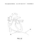 PROTECTIVE MATRIX FOR INTRACORPOREAL BIOSENSORS THAT IMPROVES     GASTROINTESTINAL LEAK DETECTION, DETECTS AIR LEAKS AFTER LUNG SURGERY,     AND MEASURES CARDIAC OUTPUT AFTER HEART SURGERY diagram and image