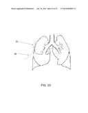 PROTECTIVE MATRIX FOR INTRACORPOREAL BIOSENSORS THAT IMPROVES     GASTROINTESTINAL LEAK DETECTION, DETECTS AIR LEAKS AFTER LUNG SURGERY,     AND MEASURES CARDIAC OUTPUT AFTER HEART SURGERY diagram and image