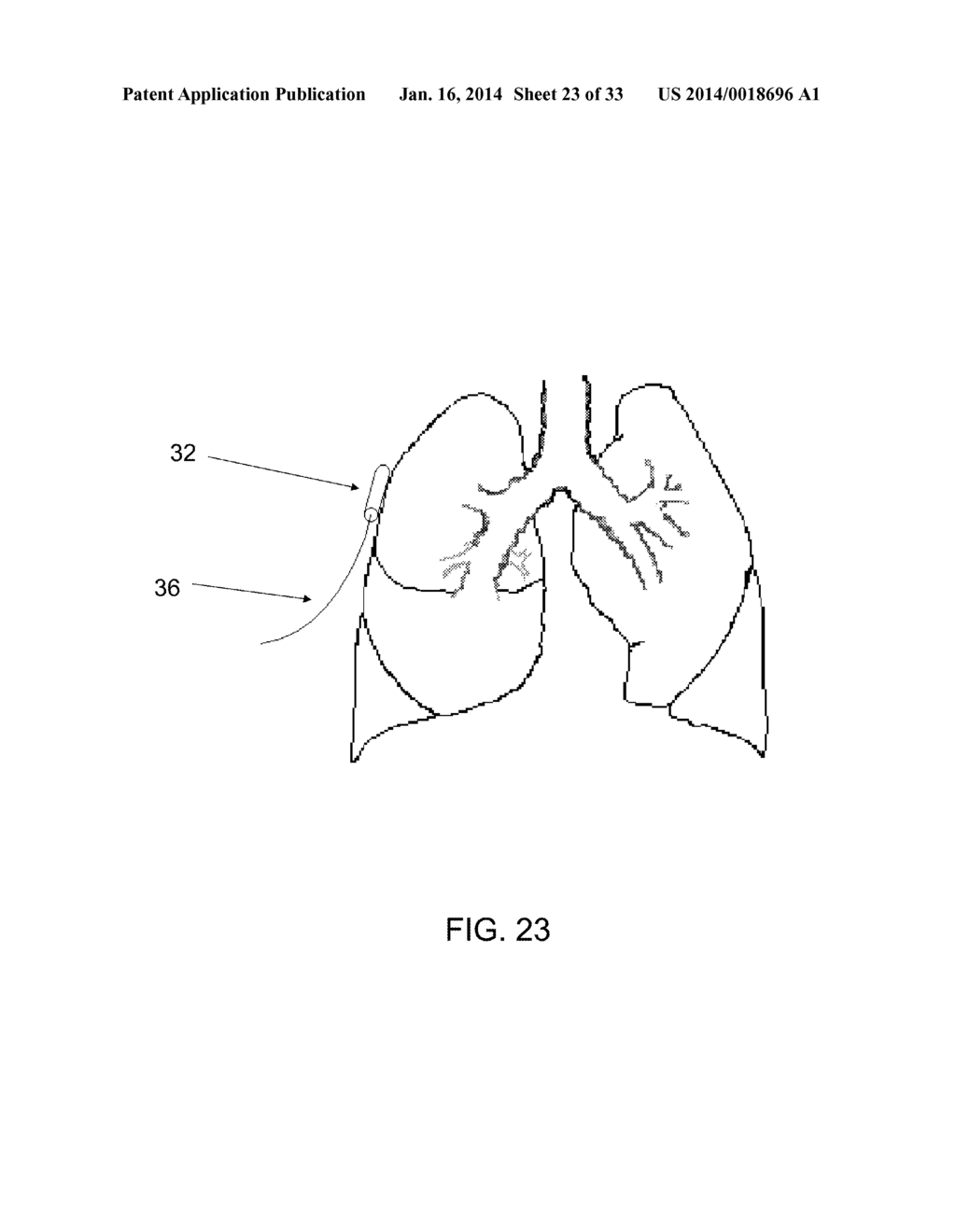 PROTECTIVE MATRIX FOR INTRACORPOREAL BIOSENSORS THAT IMPROVES     GASTROINTESTINAL LEAK DETECTION, DETECTS AIR LEAKS AFTER LUNG SURGERY,     AND MEASURES CARDIAC OUTPUT AFTER HEART SURGERY - diagram, schematic, and image 24