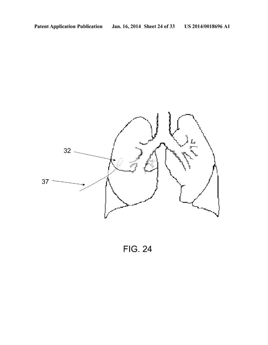 PROTECTIVE MATRIX FOR INTRACORPOREAL BIOSENSORS THAT IMPROVES     GASTROINTESTINAL LEAK DETECTION, DETECTS AIR LEAKS AFTER LUNG SURGERY,     AND MEASURES CARDIAC OUTPUT AFTER HEART SURGERY - diagram, schematic, and image 25