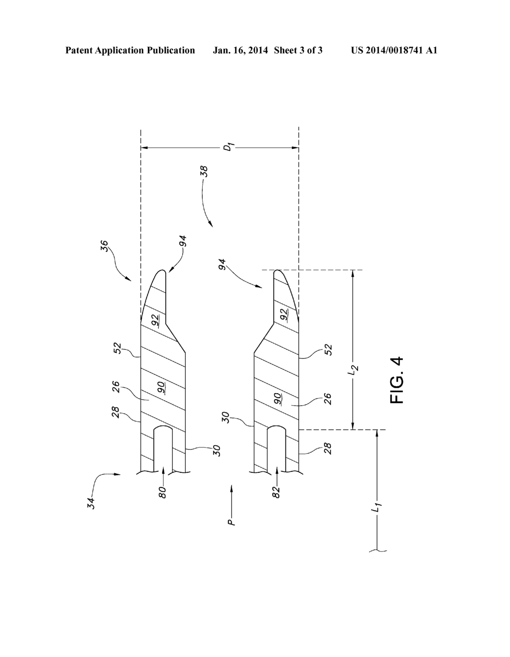 Feeding Tube Tip Reinforcement - diagram, schematic, and image 04