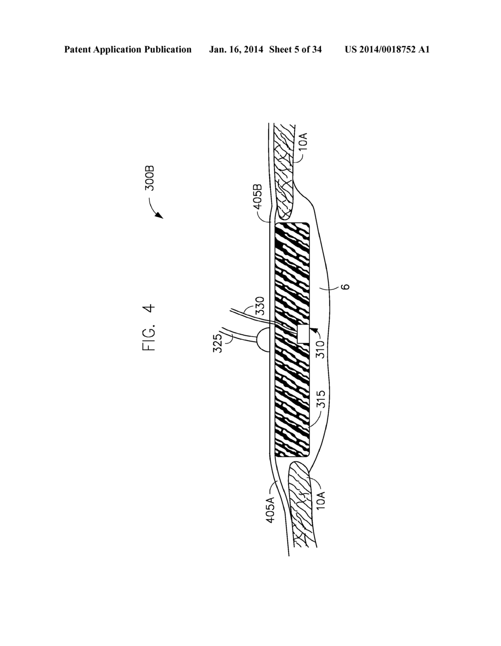 METHODS AND DRESSING SYSTEMS FOR PROMOTING HEALING OF INJURED TISSUE - diagram, schematic, and image 06