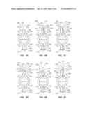 SELF-CENTERING CATHETER WITH ANTI-OCCLUSION FEATURES diagram and image