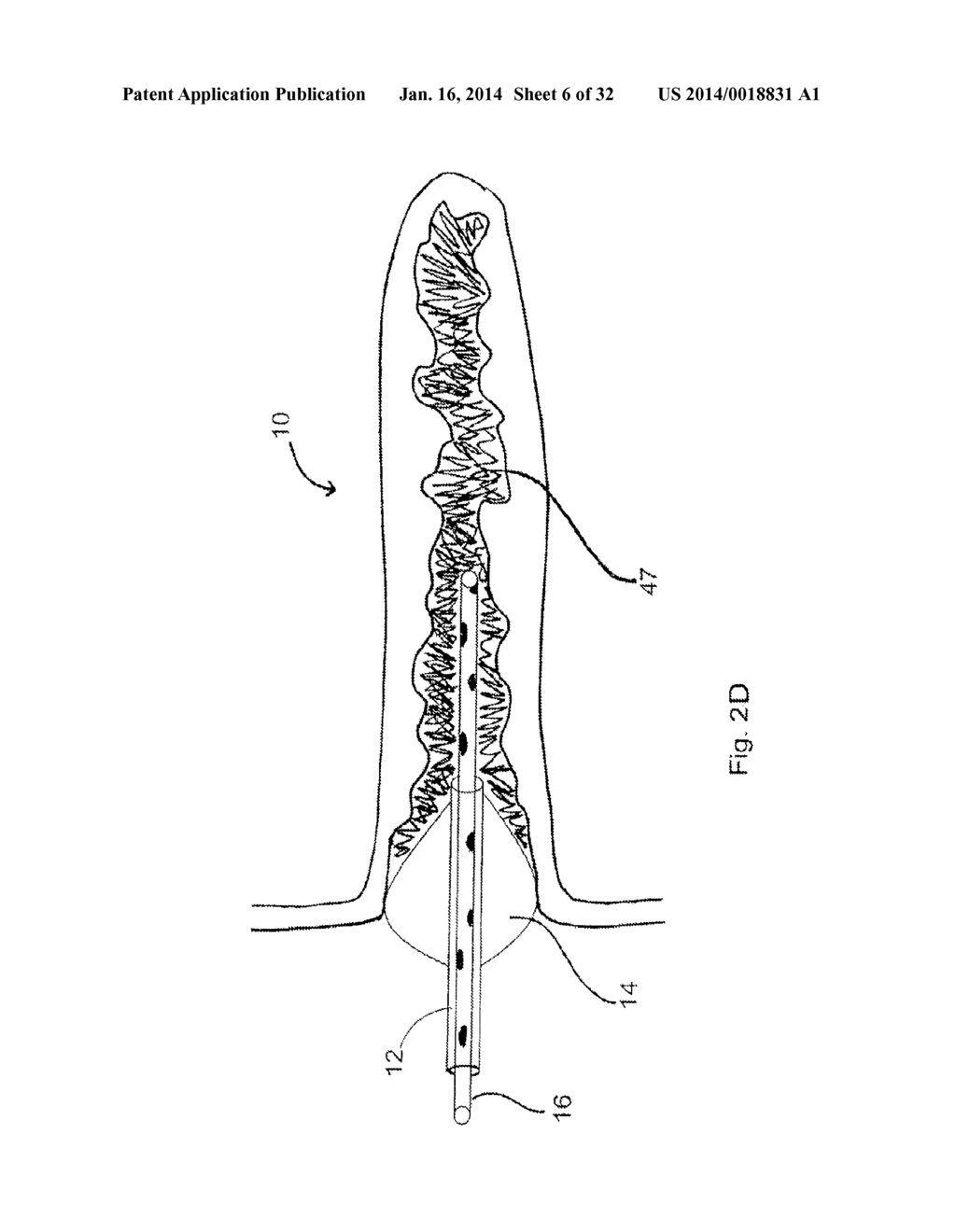 ATRIAL APPENDAGE OCCLUSION SYSTEMS AND METHODS OF USING THE SAME - diagram, schematic, and image 07