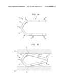 Method For Applying A Surgical Clip Having A Compliant Portion diagram and image