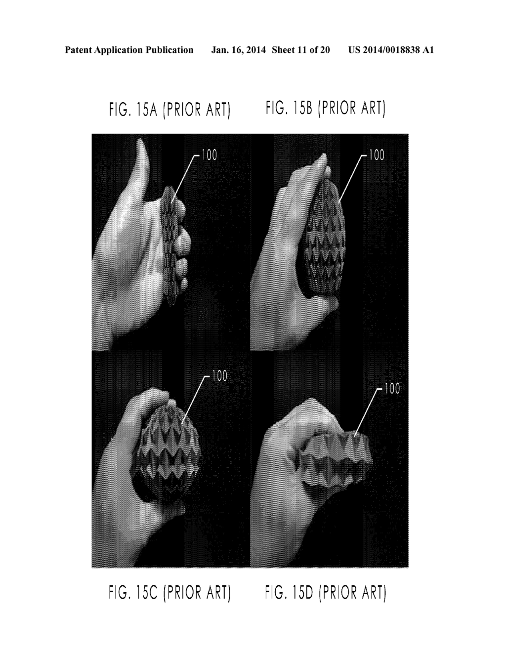BLOCKSTENT DEVICE AND METHODS OF USE - diagram, schematic, and image 12