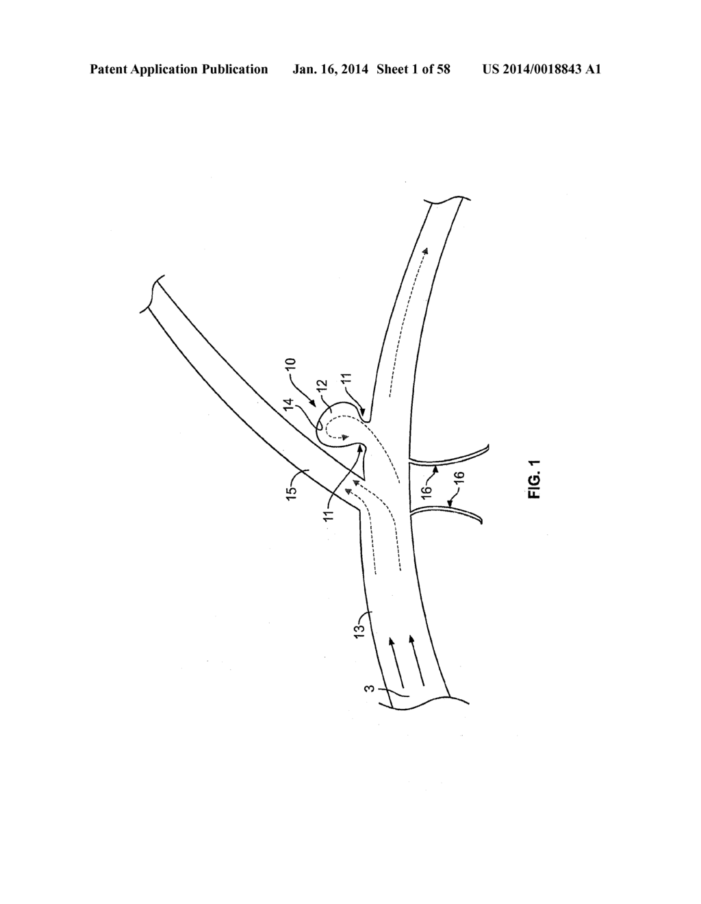 METHODS AND APPARATUS FOR LUMINAL STENTING - diagram, schematic, and image 02