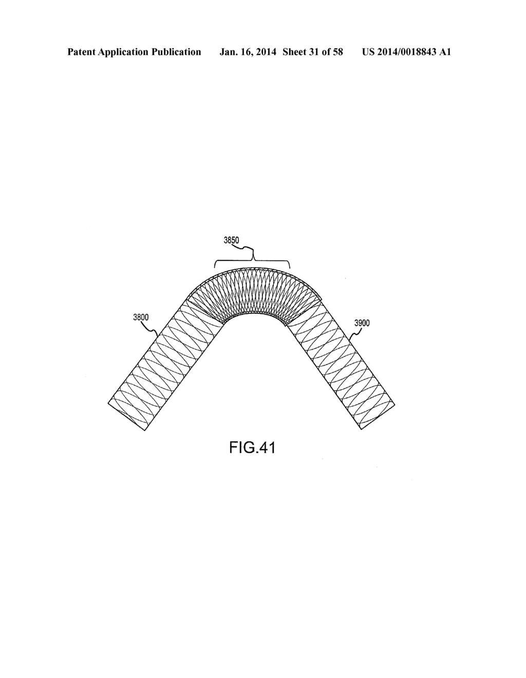 METHODS AND APPARATUS FOR LUMINAL STENTING - diagram, schematic, and image 32