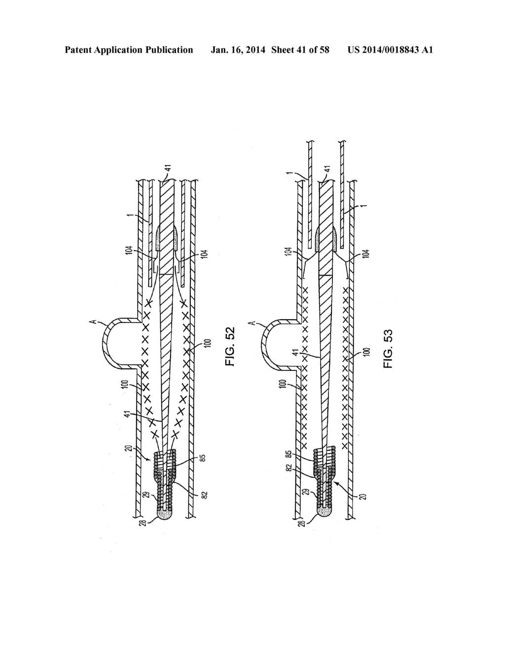 METHODS AND APPARATUS FOR LUMINAL STENTING - diagram, schematic, and image 42