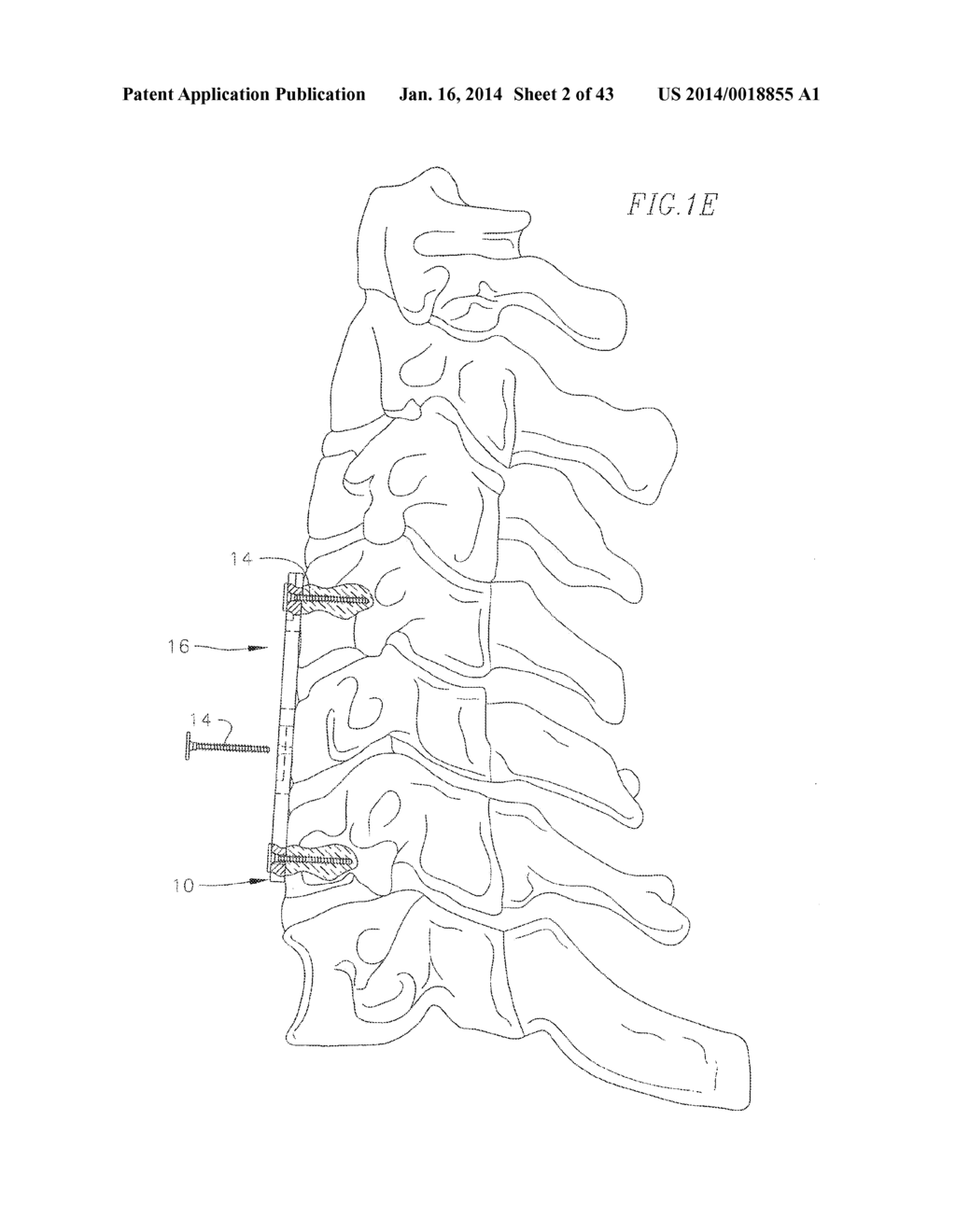 REVISABLE ANTERIOR CERVICAL PLATING SYSTEM - diagram, schematic, and image 03