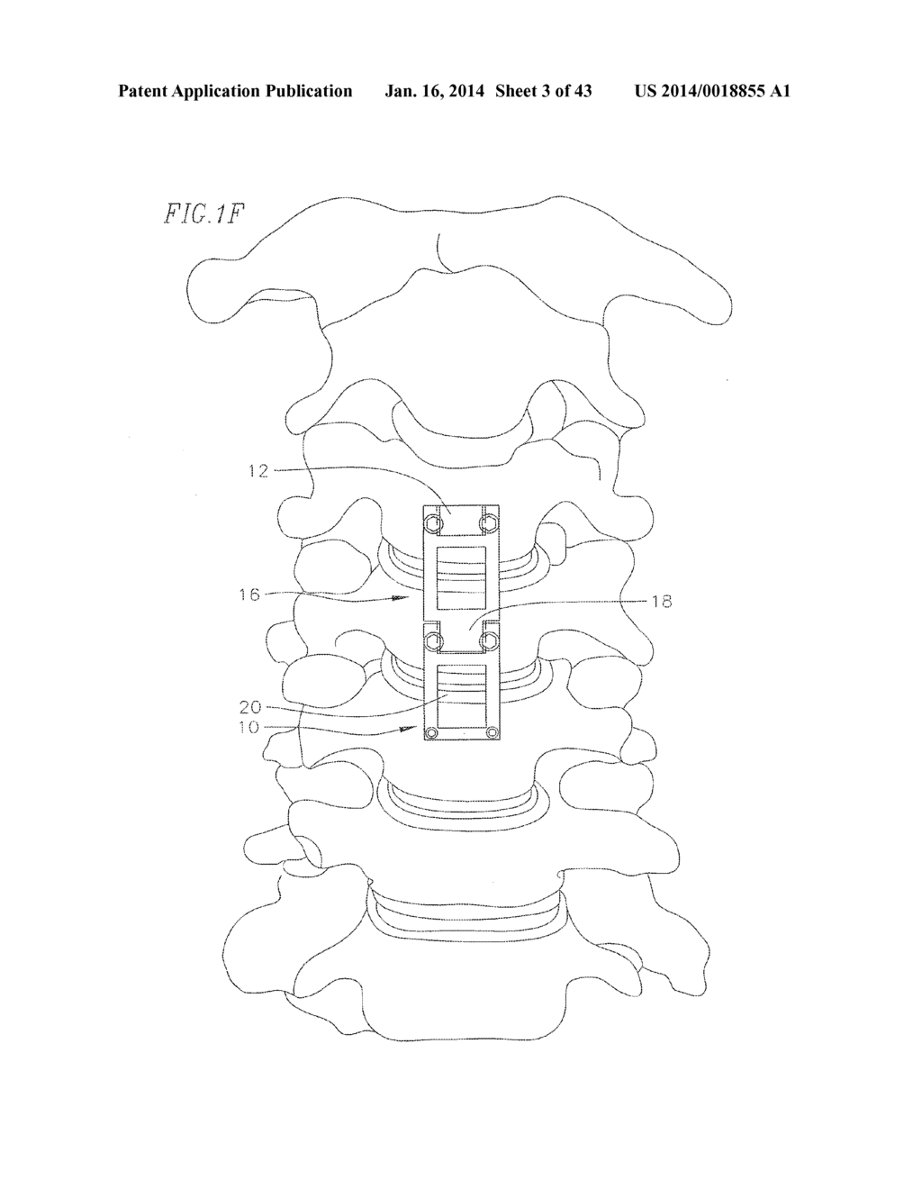 REVISABLE ANTERIOR CERVICAL PLATING SYSTEM - diagram, schematic, and image 04