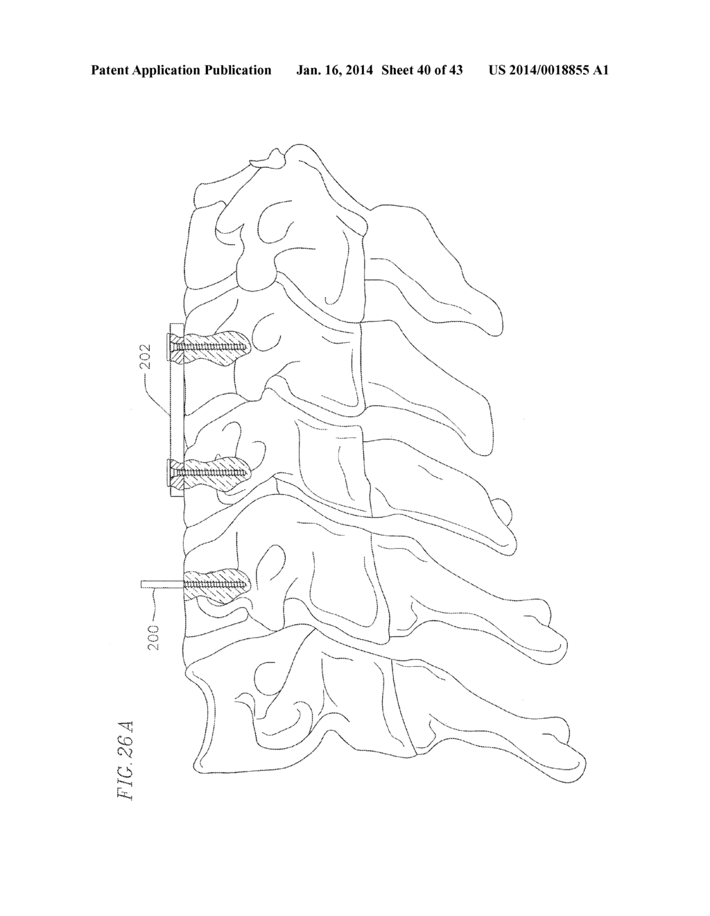 REVISABLE ANTERIOR CERVICAL PLATING SYSTEM - diagram, schematic, and image 41