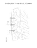 REVISABLE ANTERIOR CERVICAL PLATING SYSTEM diagram and image