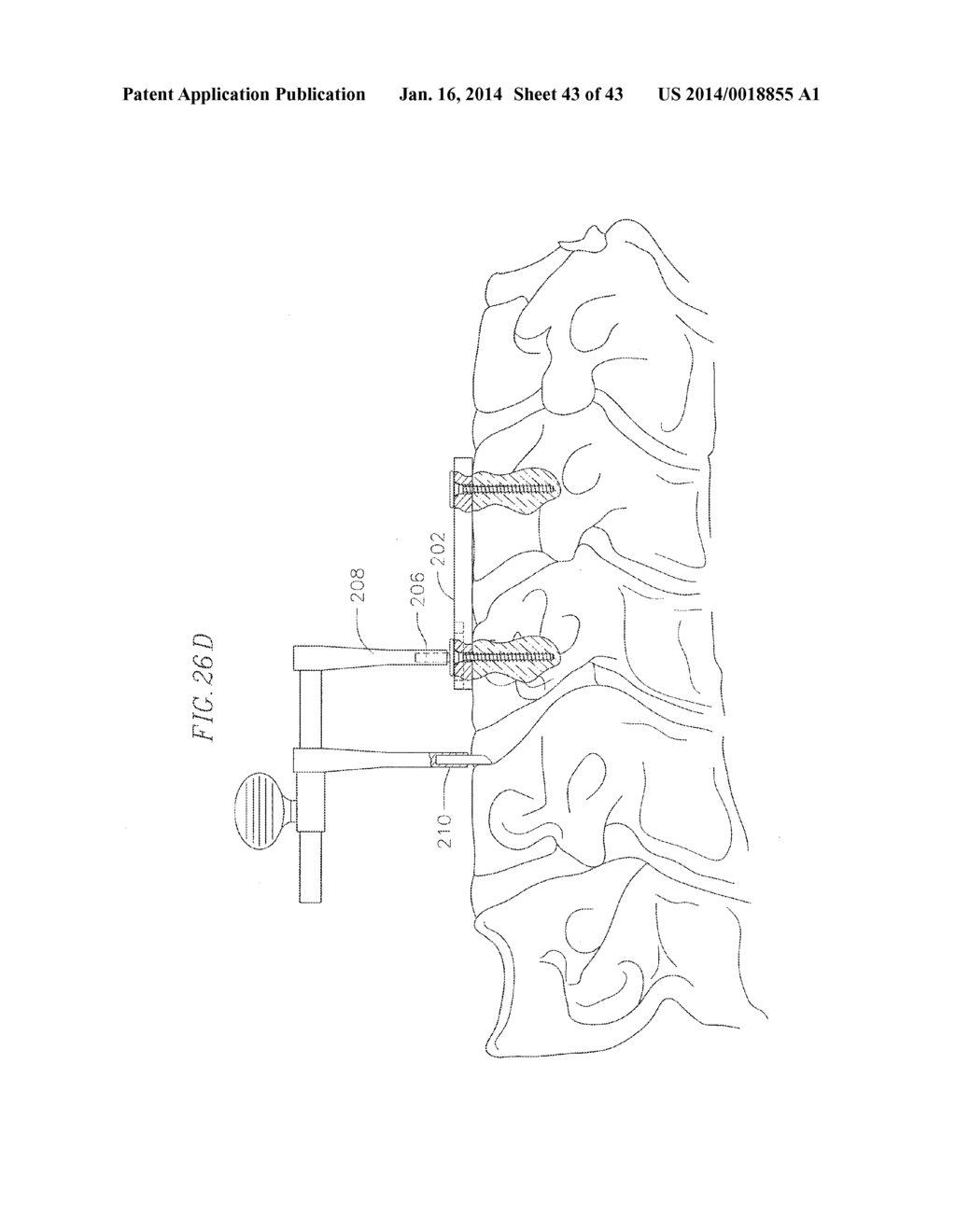 REVISABLE ANTERIOR CERVICAL PLATING SYSTEM - diagram, schematic, and image 44