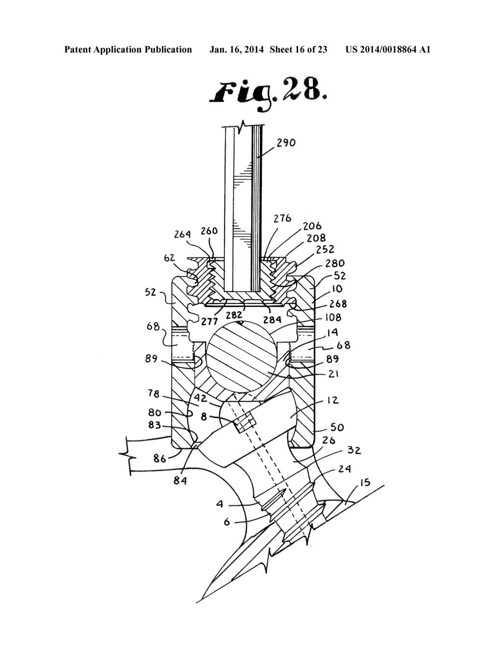 POLYAXIAL BONE SCREW WITH SHANK ARTICULATION PRESSURE INSERT AND METHOD - diagram, schematic, and image 17